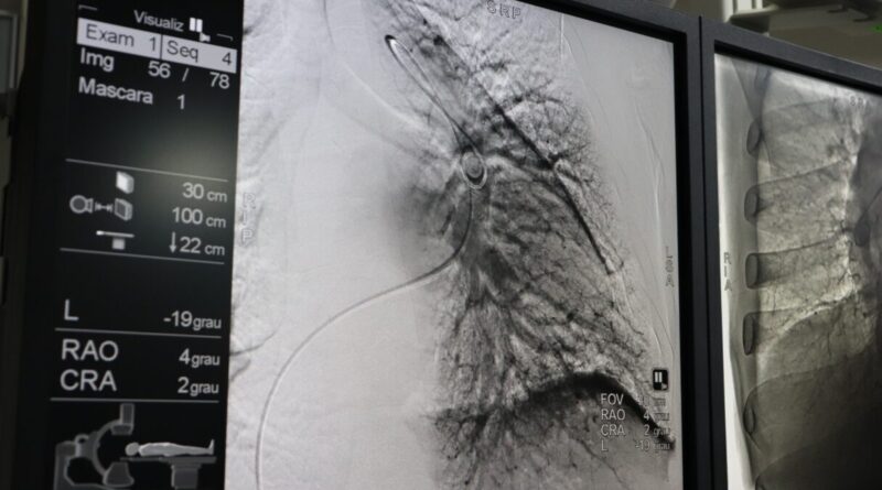 Agora realizada no HGG, angioplastia pulmonar é feita por cateterismo cardíaco, em pacientes com hipertensão pulmonar tromboembólica (Fotos: Idtech)