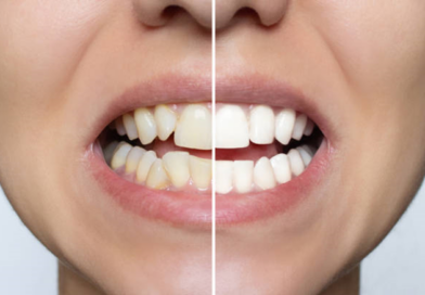 Sorriso desalinhado? Vejas 6 problemas que vão além da saúde bucal